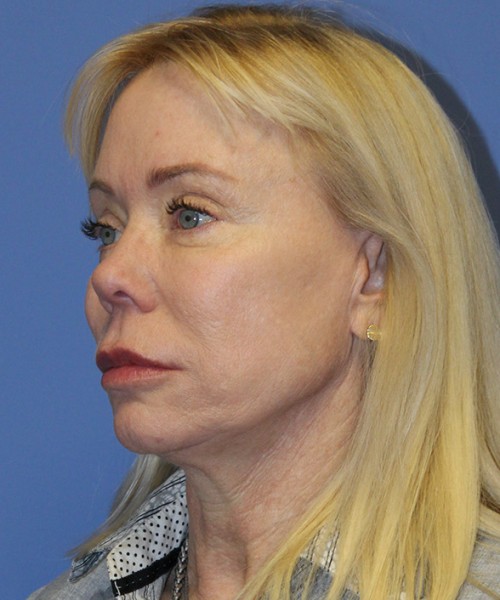 Facelift 2496 – Click HERE for more views before photo. Individual results may vary.