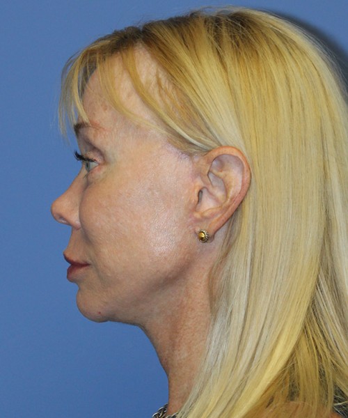 Facelift 2496 – Click HERE for more views after photo. Individual results may vary.