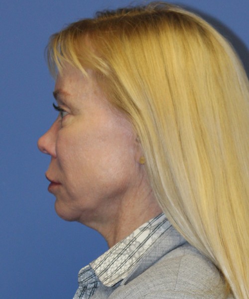 Facelift 2496 – Click HERE for more views before photo. Individual results may vary.