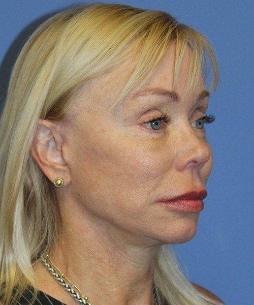Facelift 2496 – Click HERE for more views after photo. Individual results may vary.