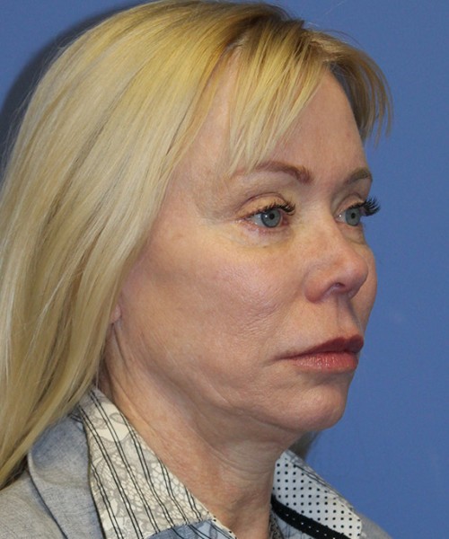 Facelift 2496 – Click HERE for more views before photo. Individual results may vary.