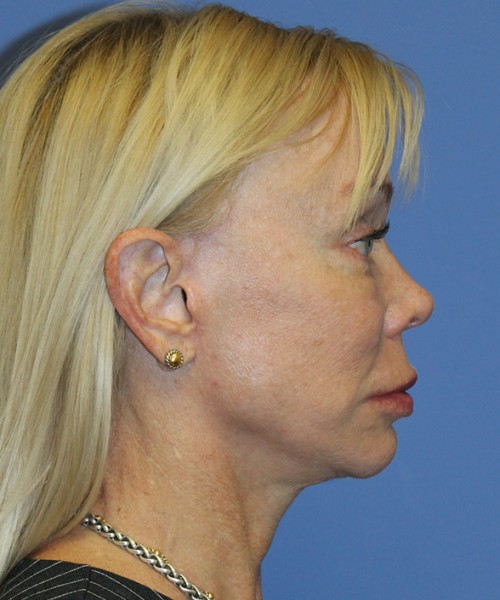 Facelift 2496 – Click HERE for more views after photo. Individual results may vary.