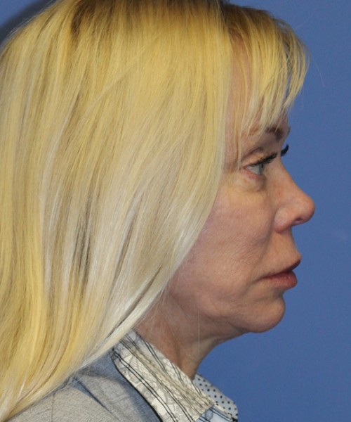 Facelift 2496 – Click HERE for more views before photo. Individual results may vary.