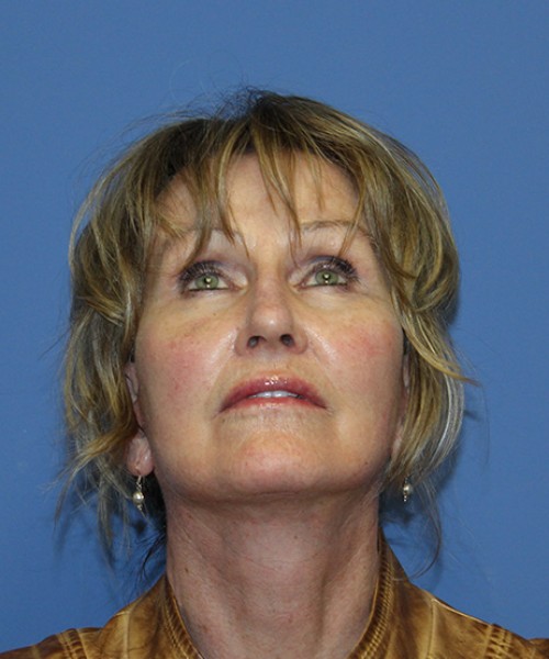 Facelift 2508 – Click HERE for more views after photo. Individual results may vary.