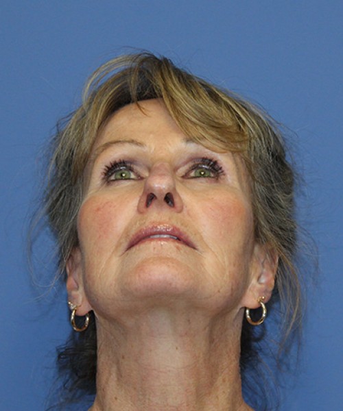 Facelift 2508 – Click HERE for more views before photo. Individual results may vary.