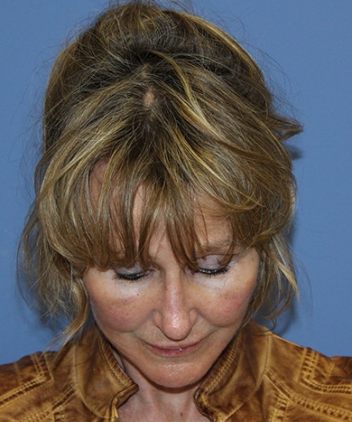 Facelift 2508 – Click HERE for more views after photo. Individual results may vary.