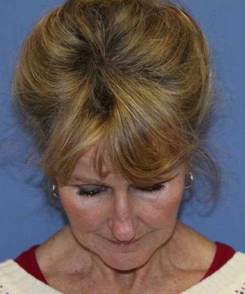 Facelift 2508 – Click HERE for more views before photo. Individual results may vary.