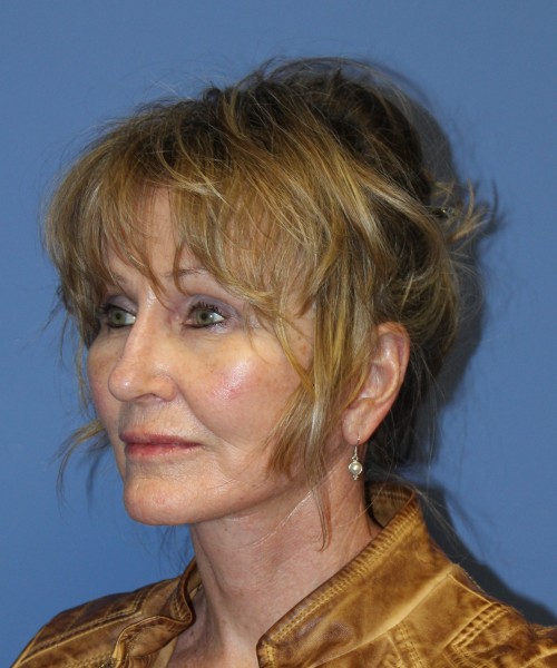 Facelift 2508 – Click HERE for more views after photo. Individual results may vary.