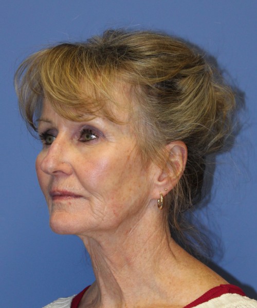 Facelift 2508 – Click HERE for more views before photo. Individual results may vary.