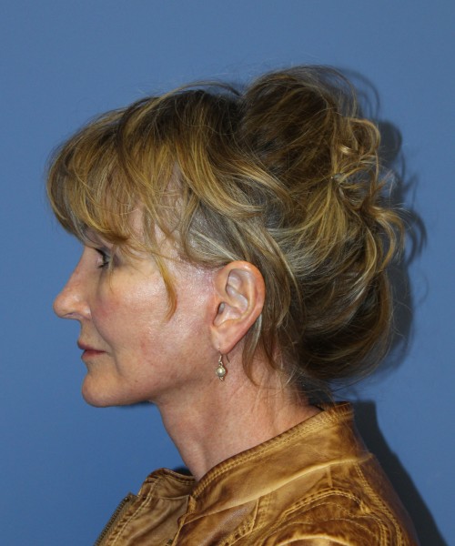Facelift 2508 – Click HERE for more views after photo. Individual results may vary.