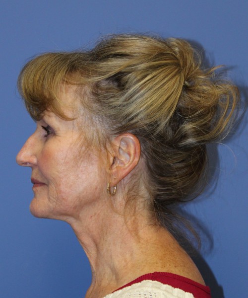 Facelift 2508 – Click HERE for more views before photo. Individual results may vary.