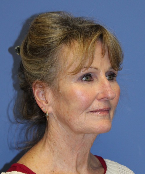 Facelift 2508 – Click HERE for more views before photo. Individual results may vary.