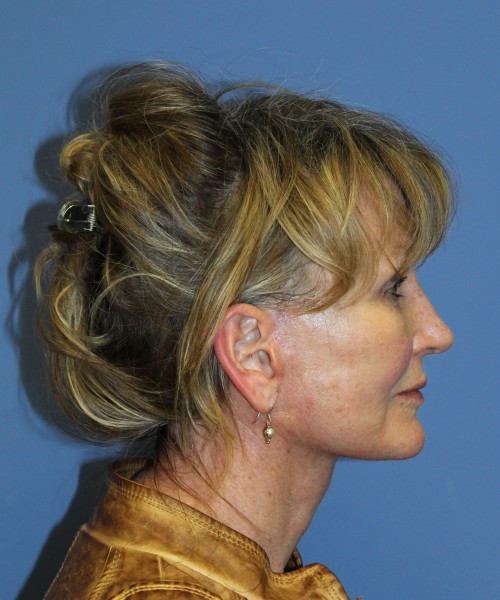 Facelift 2508 – Click HERE for more views after photo. Individual results may vary.