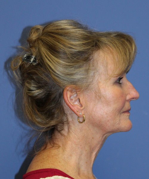 Facelift 2508 – Click HERE for more views before photo. Individual results may vary.