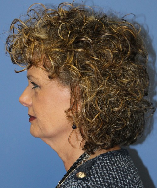 Facelift 2546 – Click HERE for more views before photo. Individual results may vary.
