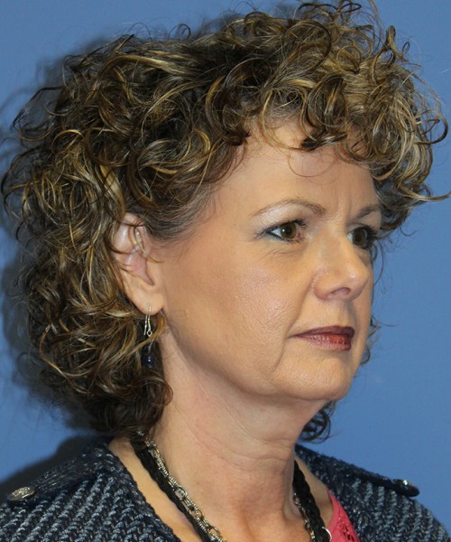 Facelift 2546 – Click HERE for more views before photo. Individual results may vary.