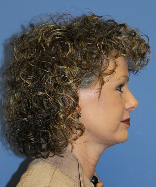 Facelift 2546 – Click HERE for more views after photo. Individual results may vary.