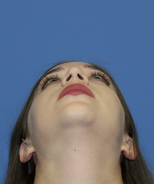 Rhinoplasty 2557 – Click HERE for more views after photo. Individual results may vary.