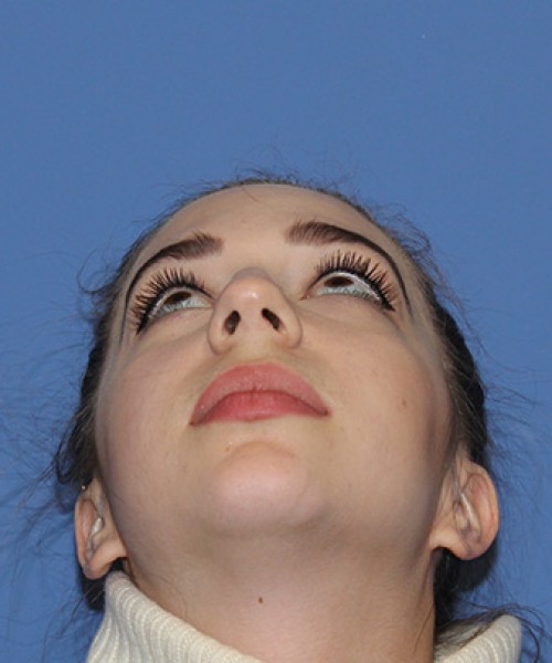 Rhinoplasty 2557 – Click HERE for more views before photo. Individual results may vary.