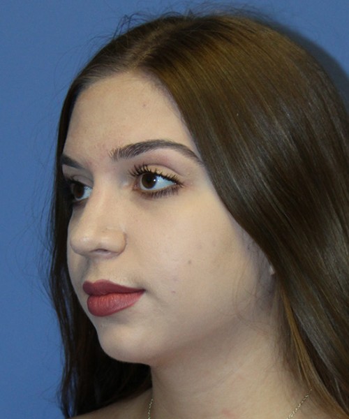 Rhinoplasty 2557 – Click HERE for more views after photo. Individual results may vary.