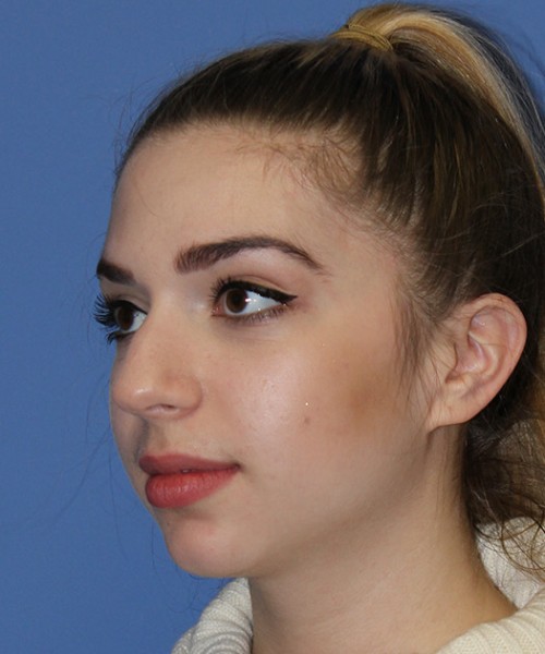 Rhinoplasty 2557 – Click HERE for more views before photo. Individual results may vary.