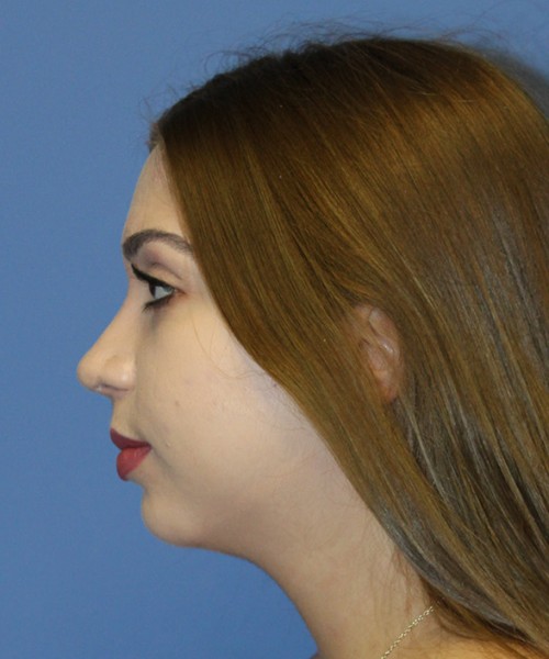 Rhinoplasty 2557 – Click HERE for more views after photo. Individual results may vary.