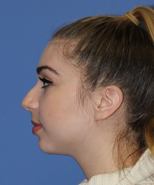 Rhinoplasty 2557 – Click HERE for more views before photo. Individual results may vary.