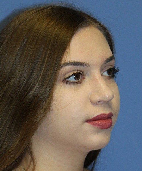 Rhinoplasty 2557 – Click HERE for more views after photo. Individual results may vary.