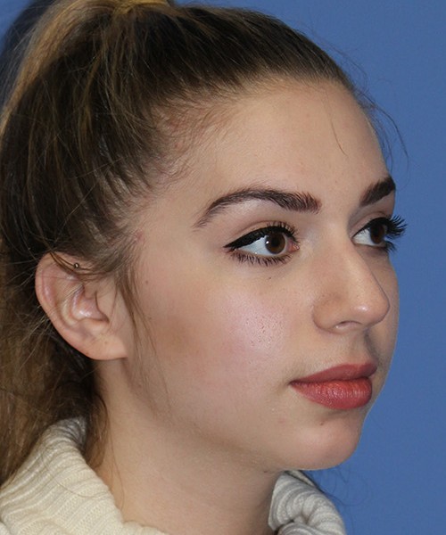 Rhinoplasty 2557 – Click HERE for more views before photo. Individual results may vary.