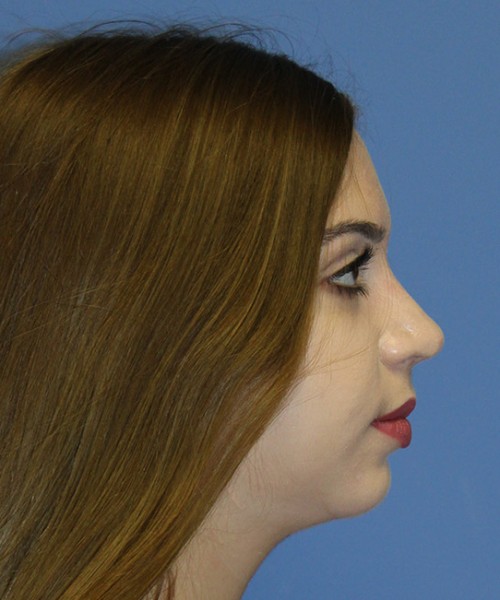 Rhinoplasty 2557 – Click HERE for more views after photo. Individual results may vary.