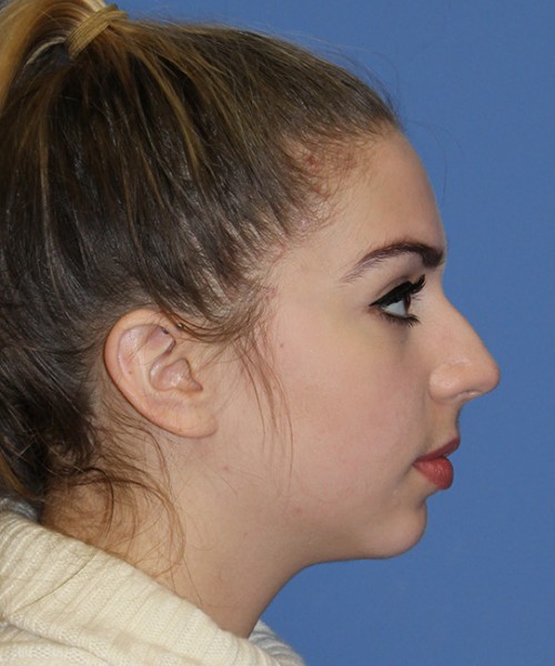 Rhinoplasty 2557 – Click HERE for more views before photo. Individual results may vary.