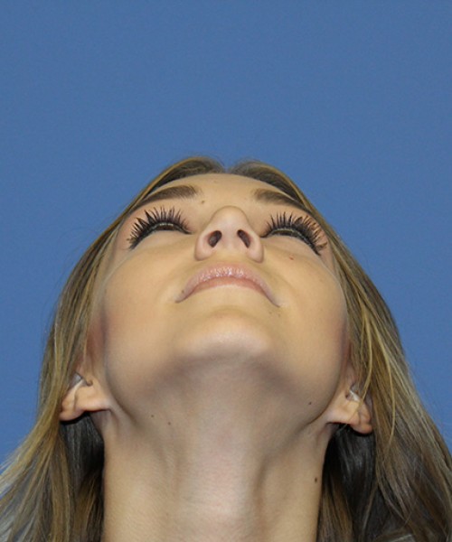 Rhinoplasty 2587 – Click HERE for more views after photo. Individual results may vary.