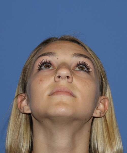 Rhinoplasty 2587 – Click HERE for more views before photo. Individual results may vary.