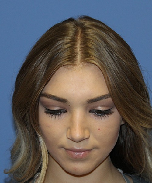 Rhinoplasty 2587 – Click HERE for more views after photo. Individual results may vary.