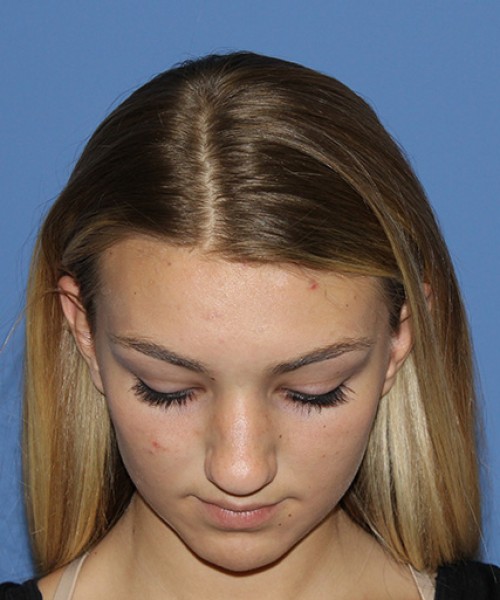 Rhinoplasty 2587 – Click HERE for more views before photo. Individual results may vary.