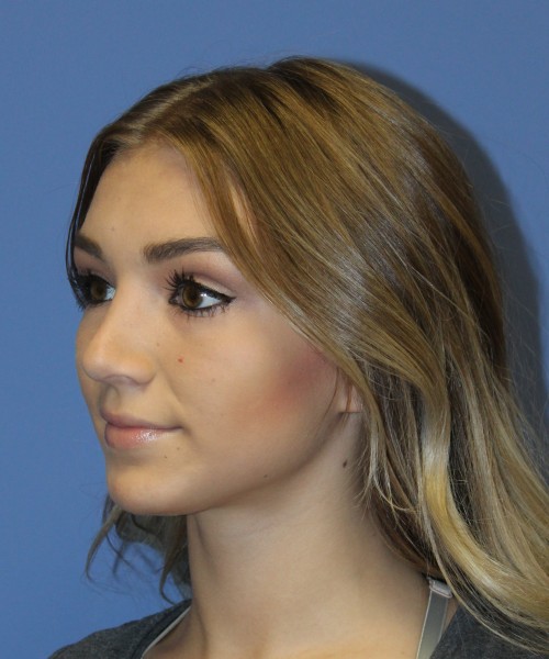 Rhinoplasty 2587 – Click HERE for more views after photo. Individual results may vary.