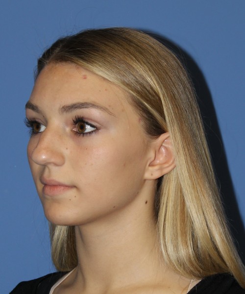 Rhinoplasty 2587 – Click HERE for more views before photo. Individual results may vary.