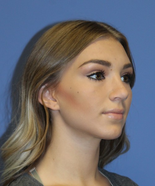 Rhinoplasty 2587 – Click HERE for more views after photo. Individual results may vary.