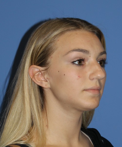Rhinoplasty 2587 – Click HERE for more views before photo. Individual results may vary.