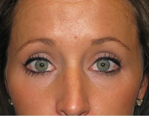 Botox, Dysport, Dermal Filler 2627 – Click HERE for more views after photo. Individual results may vary.