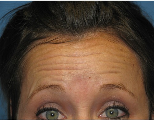 Botox, Dysport, Dermal Filler 2627 – Click HERE for more views before photo. Individual results may vary.