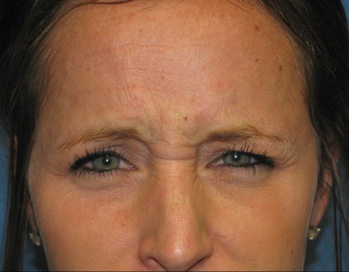 Botox, Dysport, Dermal Filler 2627 – Click HERE for more views before photo. Individual results may vary.