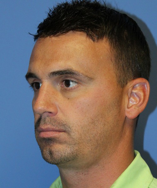 Chin Augmentation 2637 – Click HERE for more views after photo. Individual results may vary.