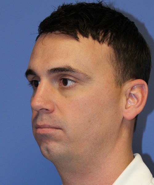 Chin Augmentation 2637 – Click HERE for more views before photo. Individual results may vary.