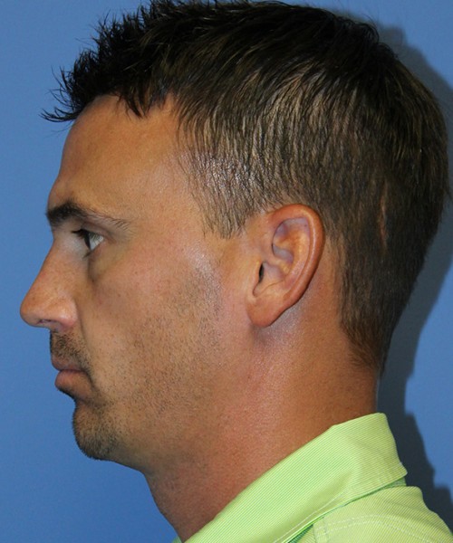 Chin Augmentation 2637 – Click HERE for more views after photo. Individual results may vary.