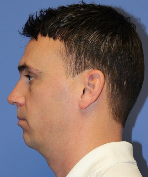 Chin Augmentation 2637 – Click HERE for more views before photo. Individual results may vary.