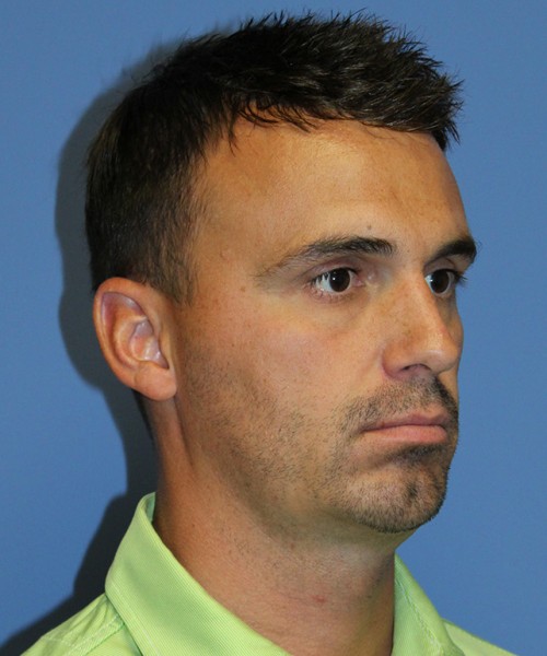 Chin Augmentation 2637 – Click HERE for more views after photo. Individual results may vary.