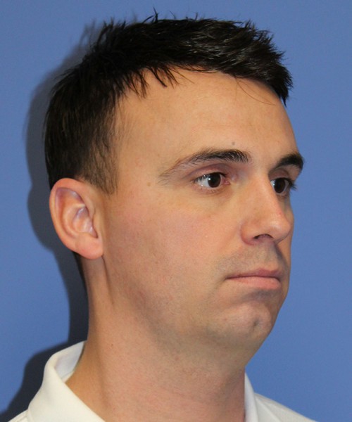 Chin Augmentation 2637 – Click HERE for more views before photo. Individual results may vary.