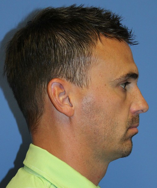 Chin Augmentation 2637 – Click HERE for more views after photo. Individual results may vary.