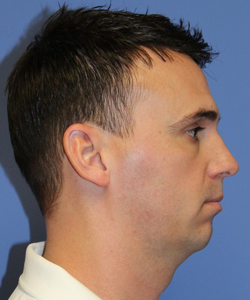 Chin Augmentation 2637 – Click HERE for more views before photo. Individual results may vary.